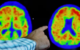 Araştırma: Alzheimer’a karşı yeni umut Viagra olabilir