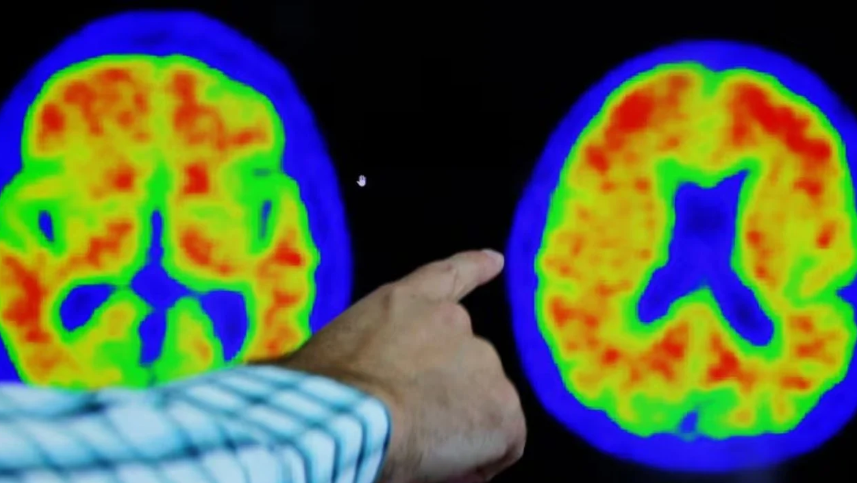 Araştırma: Alzheimer’a karşı yeni umut Viagra olabilir